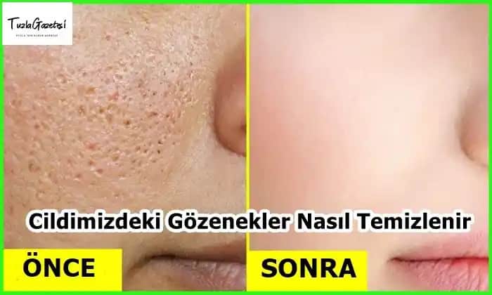 Siyah Gözenekleri Temizleme Yöntemleri ve Cilt Bakımında Etkili Tavsiyeler