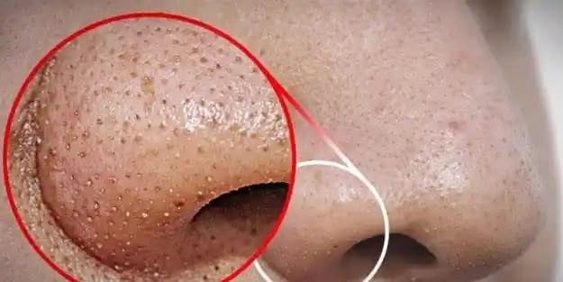 Siyah Noktalar ve Genişleyen Gözenekler İçin Etkili Temizlik ve Bakım Yöntemleri