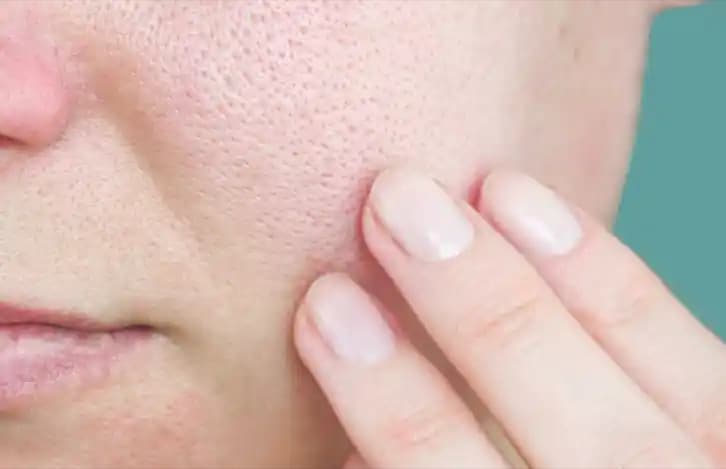 Tıkanmış Gözenekler ve Çözüm Yolları: Cilt Sağlığını Koruma Rehberi (75-90 karakter)