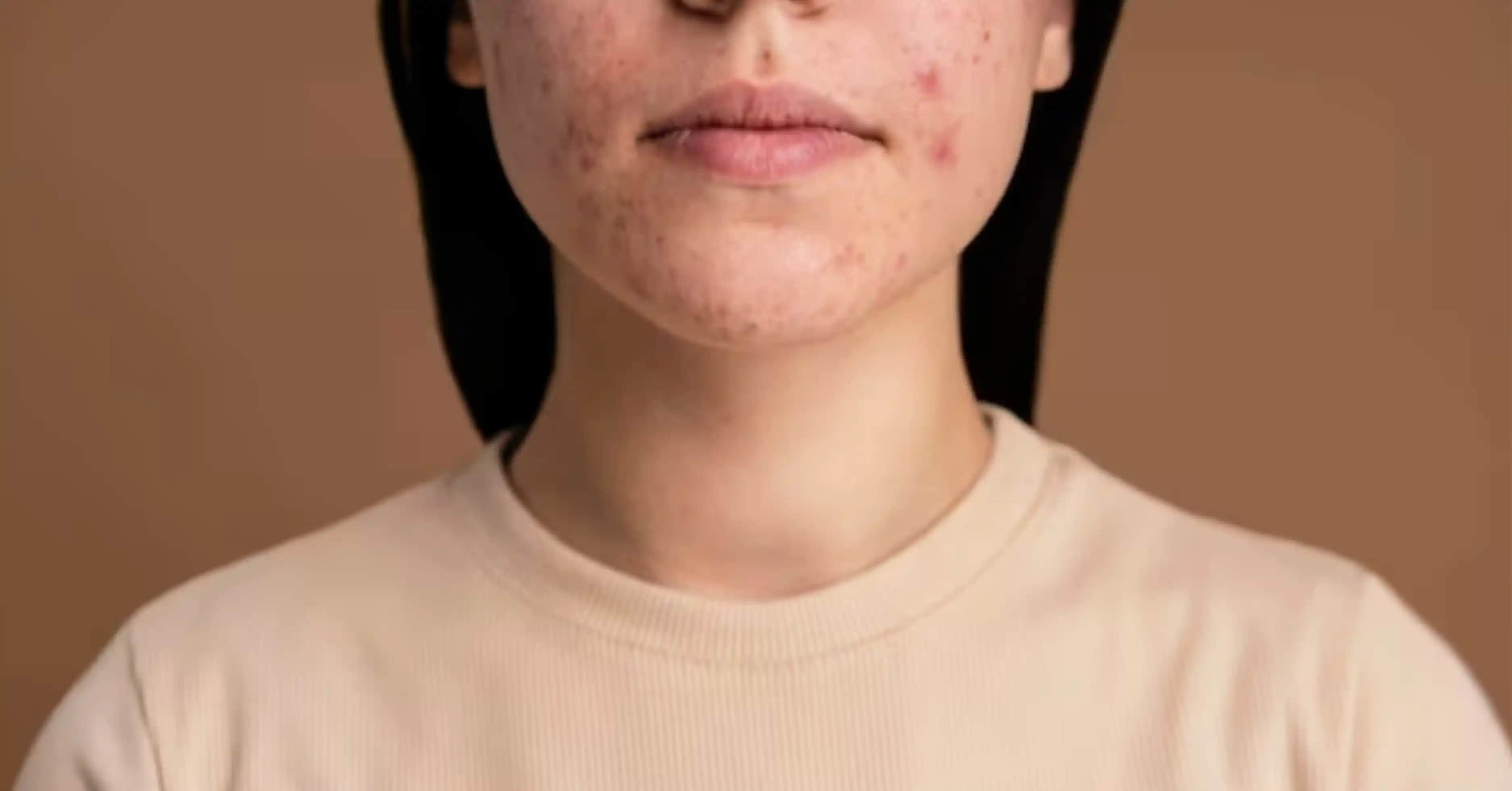 Yüz Lekeleri Nedenleri Türleri ve Etkili Çözüm Yöntemleri Hakkında Kapsamlı Bilgi