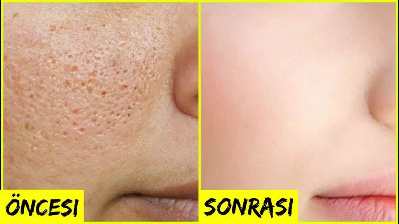 Yüzdeki Gözenekleri Sıkılaştırmak İçin Etkili Yöntemler ve Uzman Tavsiyeleri