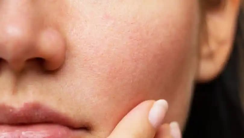 Yüzdeki Kuruluğu Gideren Etkili Çözümler ve Cilt Bakım İpuçları