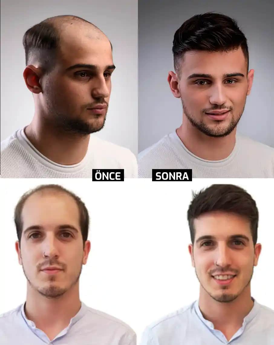 Erkekler İçin Protez Saç Çözümleri: Doğal Görünüm ve Güncel Uygulama Yöntemleri