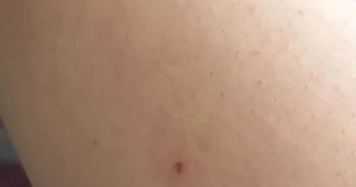 Lazer Epilasyon Sonrası Kızarıklık Nedenleri ve Etkili Çözüm Yöntemleri