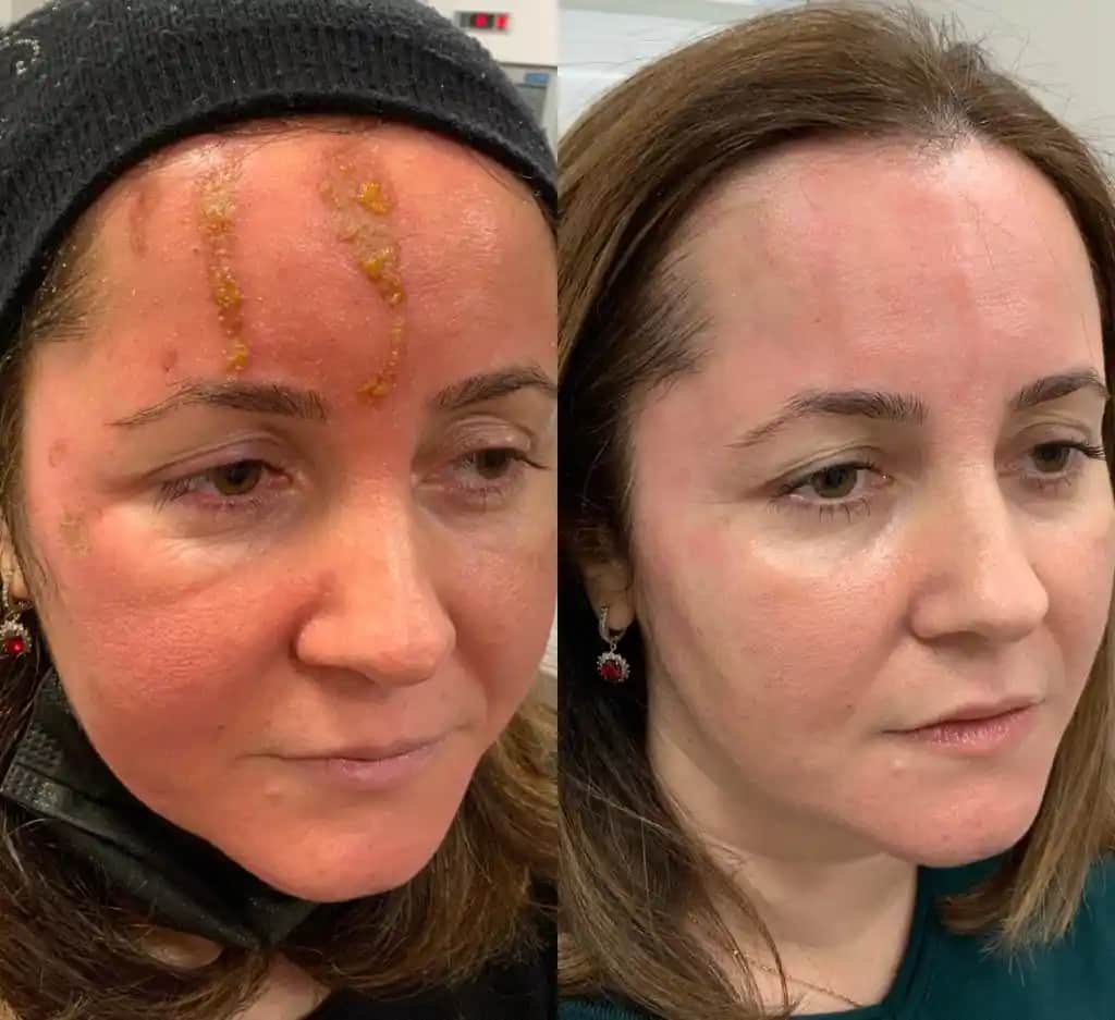 Lazer Sonrası Cilt Bakımı: Doğru Uygulamalar ve Dikkat Edilmesi Gerekenler