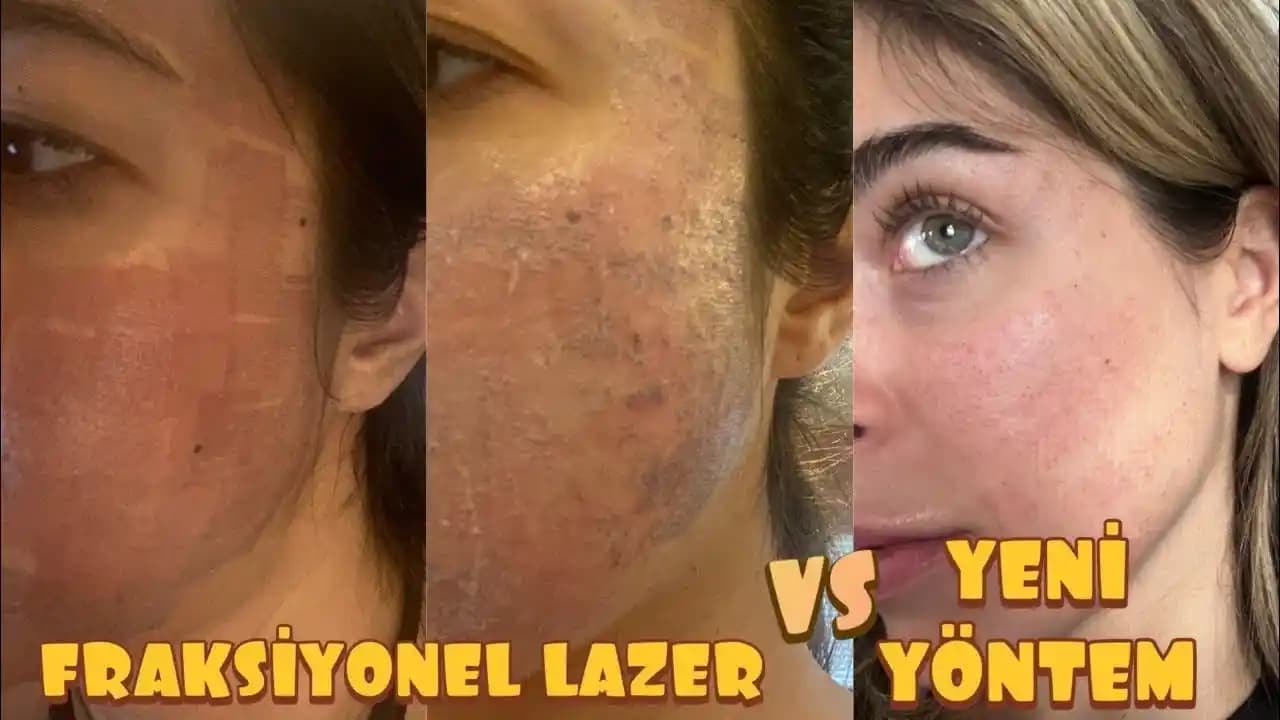 Lazer Sonrası Kızarıklık Nasıl Geçer En Etkili Yöntemler ve Bilinmesi Gerekenler