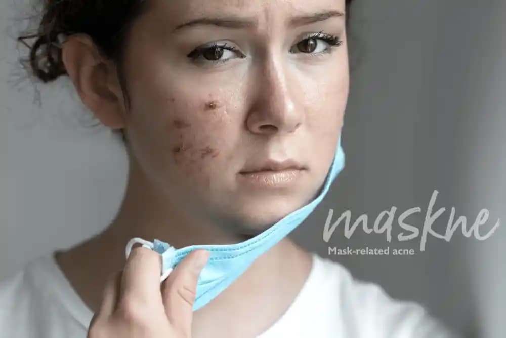 Maskne Nedir, Neden Oluşur ve Cilt Sağlığını Koruma Yöntemleri
