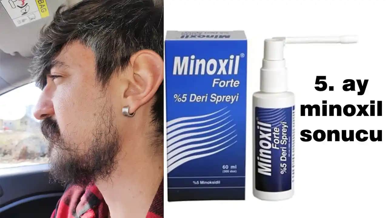 Minoxil Sakal Serumu: Sakal Büyümesini Destekleyen Etkili Çözüm Nedir?