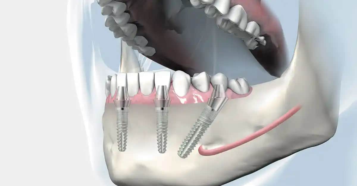 Protez Diş Temizliği ve Bakımında Diş İpi Kullanımının Önemi ve Uygun Fiyatlar