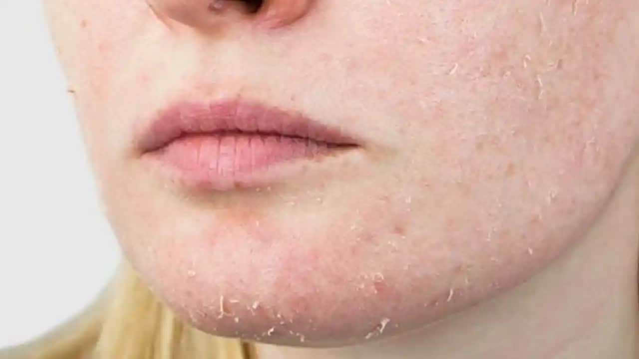 Pul Pul Dökülen Cilt: Nedenleri ve Etkili Çözüm Yolları Hakkında Detaylı Bilgiler