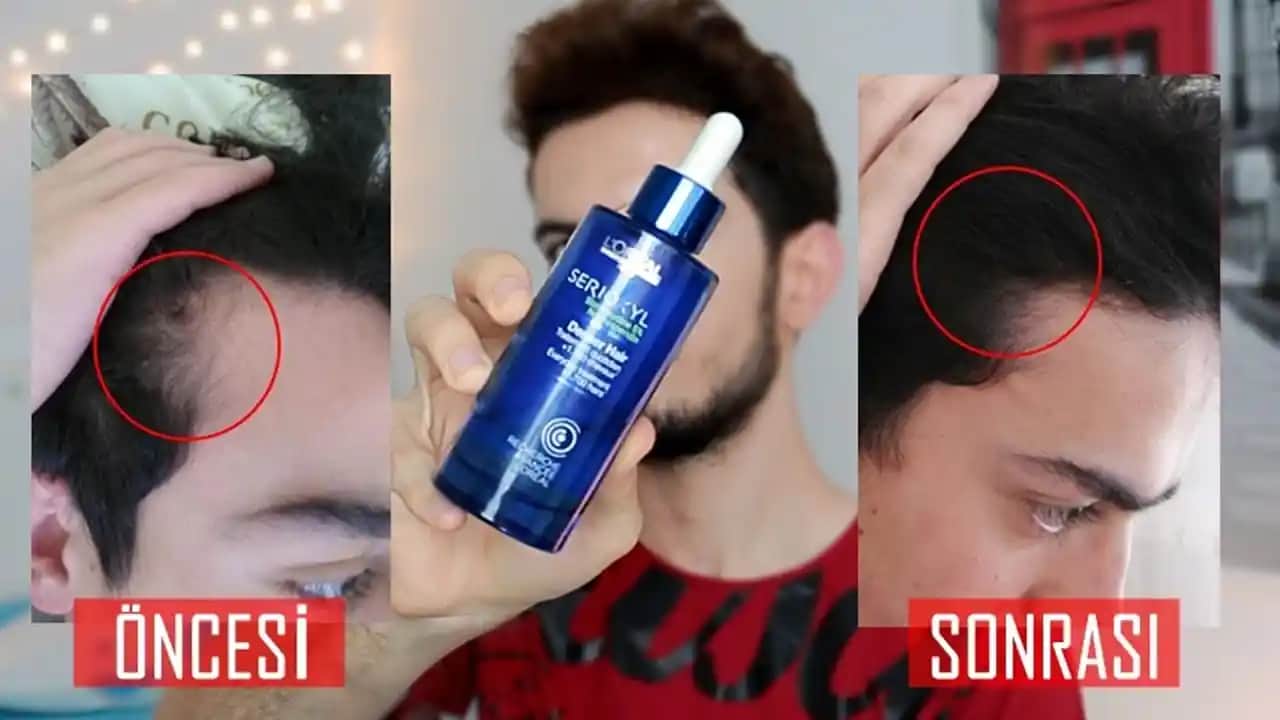 Radix Sprey Öncesi ve Sonrası: Saç Dökülmesine Karşı Etkili Çözüm ve Kullanıcı Deneyimleri