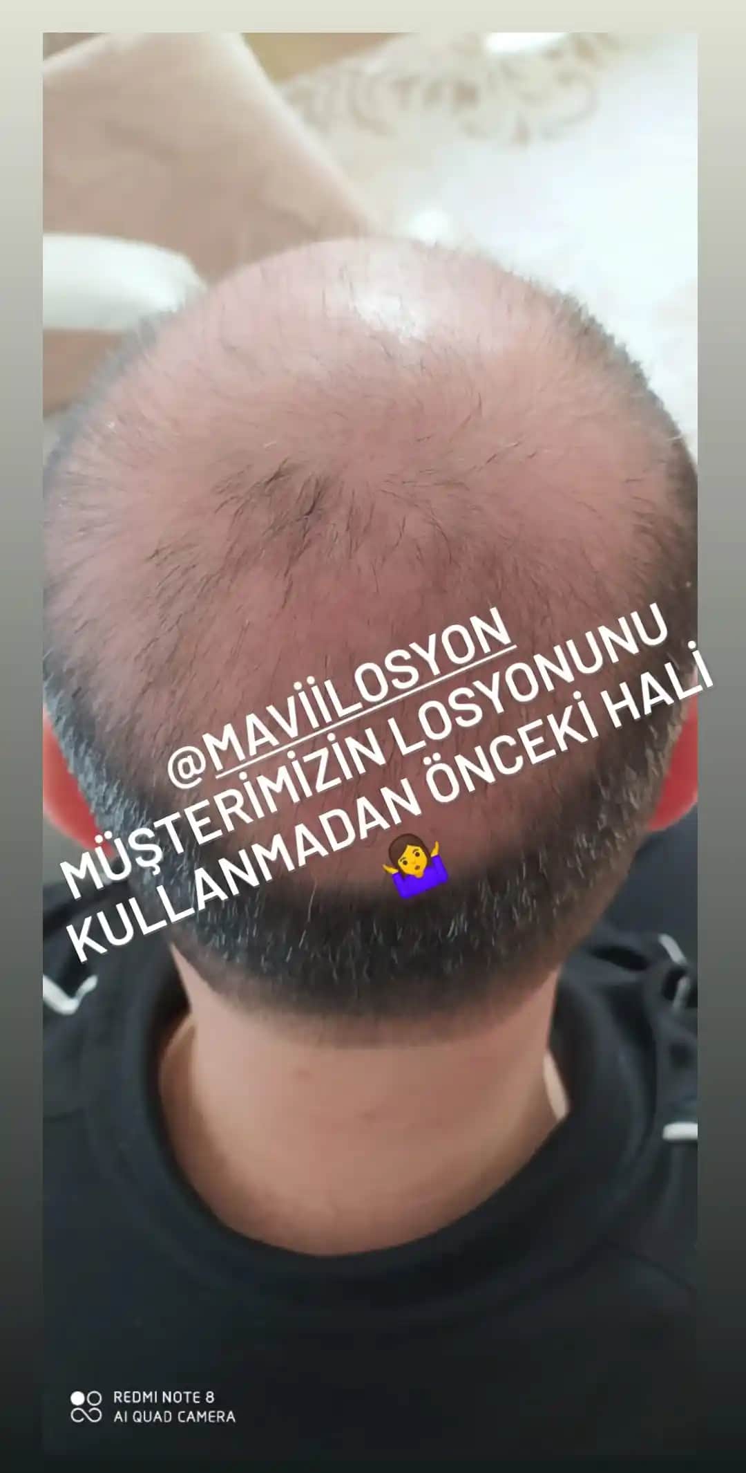 Saç Çıkaran Serumler: Saç Dökülmesine Karşı Etkili ve Güvenilir Çözümler Hakkında Detaylı Rehber