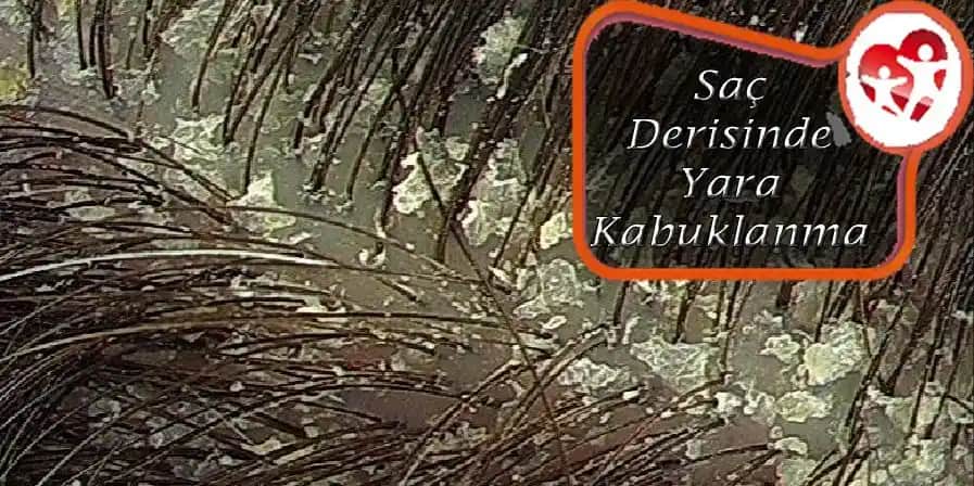 Saç Derisinde Beyaz Kabuklanma Nedenleri ve Etkili Tedavi Yöntemleri