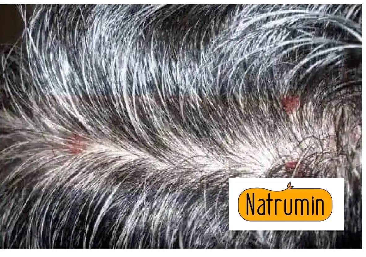 Saç Derisinde Döküntü ve Pullanma Sorunlarının Nedenleri ve Tedavi Yöntemleri