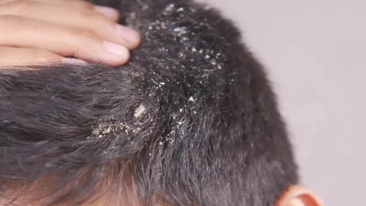 Saç Derisinde Döküntü ve Pullanmanın Nedenleri, Belirtileri ve Çözüm Yolları