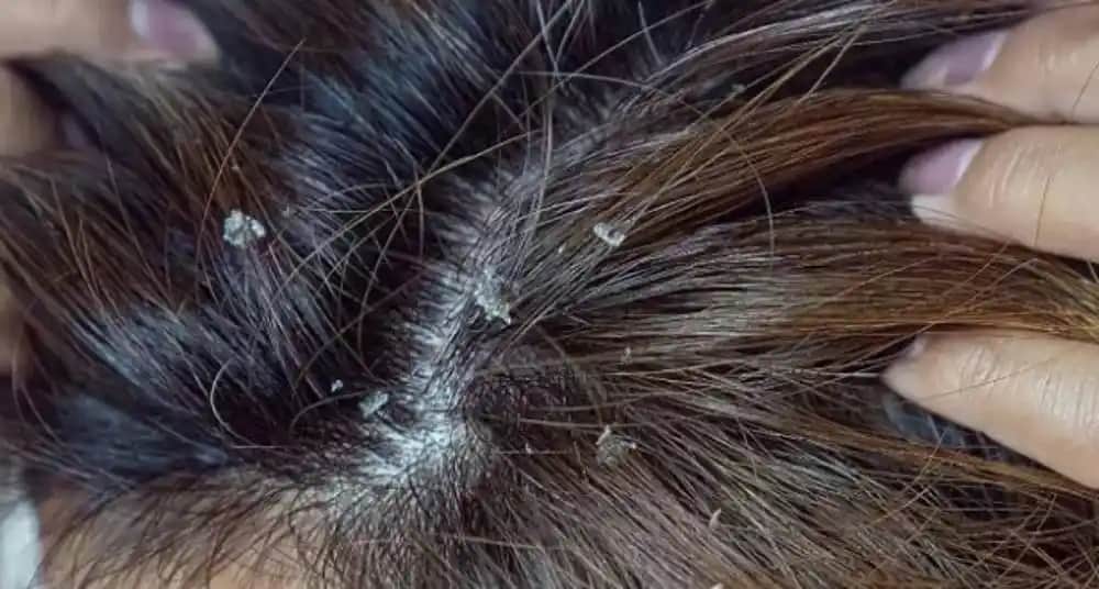 Saç Derisinde Kabuklanma Nedenleri, Belirtileri ve Etkili Çözüm Yolları