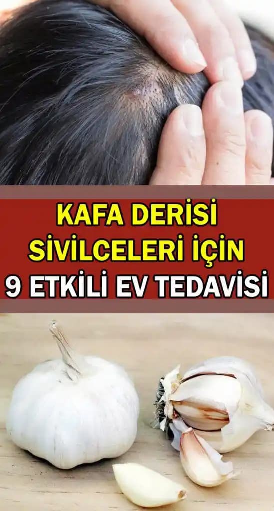 Saç Derisinde Sivilce Nasıl Tedavi Edilir ve Önlenir Profesyonel ve Doğal Çözüm Yöntemleri