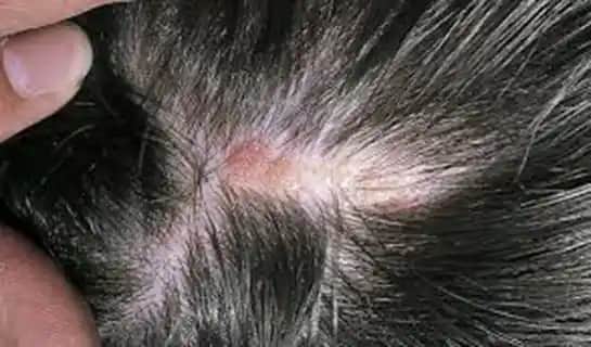 Saç Derisinde Siyah Nokta Nedenleri, Belirtileri ve Etkili Çözüm Yolları