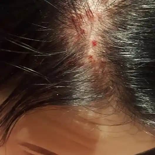 Saç Diplerindeki Kabuklanma Nedenleri ve Etkili Çözüm Yöntemleri