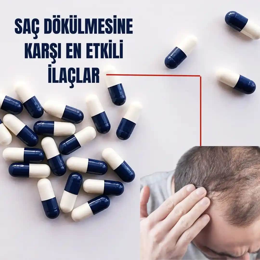 Saç Dökülmesini Engelleyen İlaçlar ve Doğal Çözümler Hakkında Güncel Bilgiler