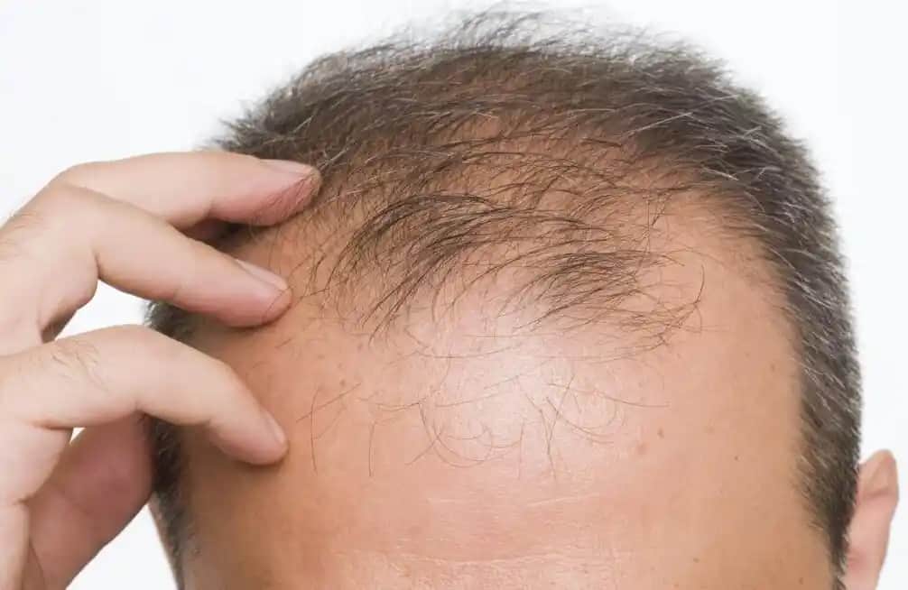 Saç Dökülmesini Önleme ve Tedavi Etme Yolları: Etkili Yöntemler ve Uzman Tavsiyeleri