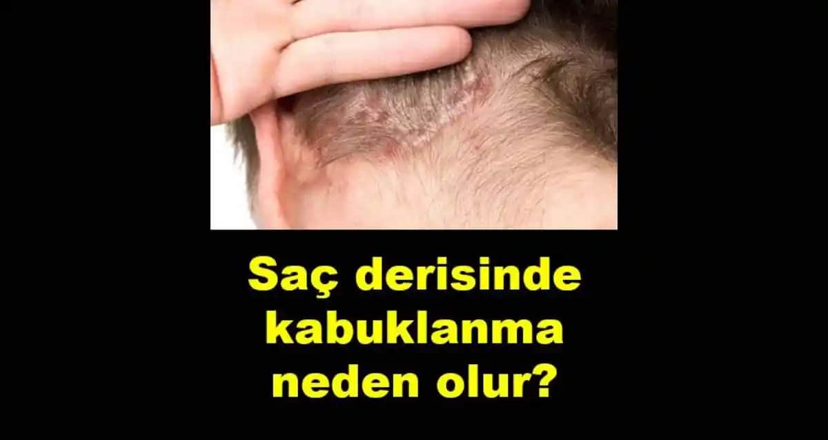 Saç ve Sakal Derisinde Kabuklanma Nedenleri ve Etkili Çözüm Yöntemleri