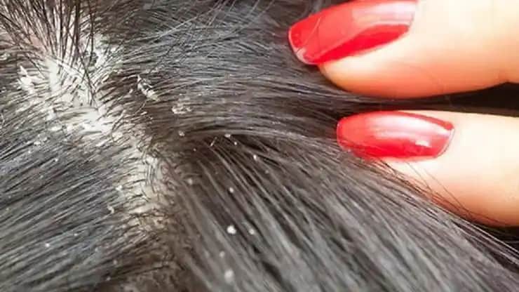 Saçta Aşırı Kepeklenmenin Nedenleri, Tedavi Yöntemleri ve Önleme İpuçları