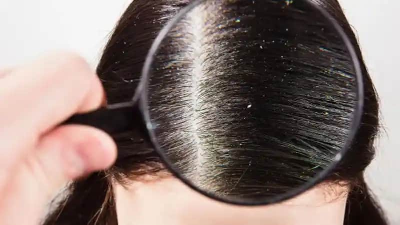 Saçta Beyaz Kepek Gibi Görünen Durumlar ve Çözüm Yolları Hakkında Detaylı Bilgi