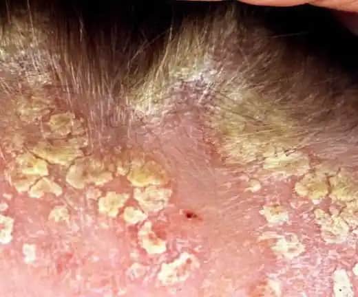 Saçta Kabuklu Kepek Nedenleri, Belirtileri ve Etkili Çözüm Yolları Rehberi