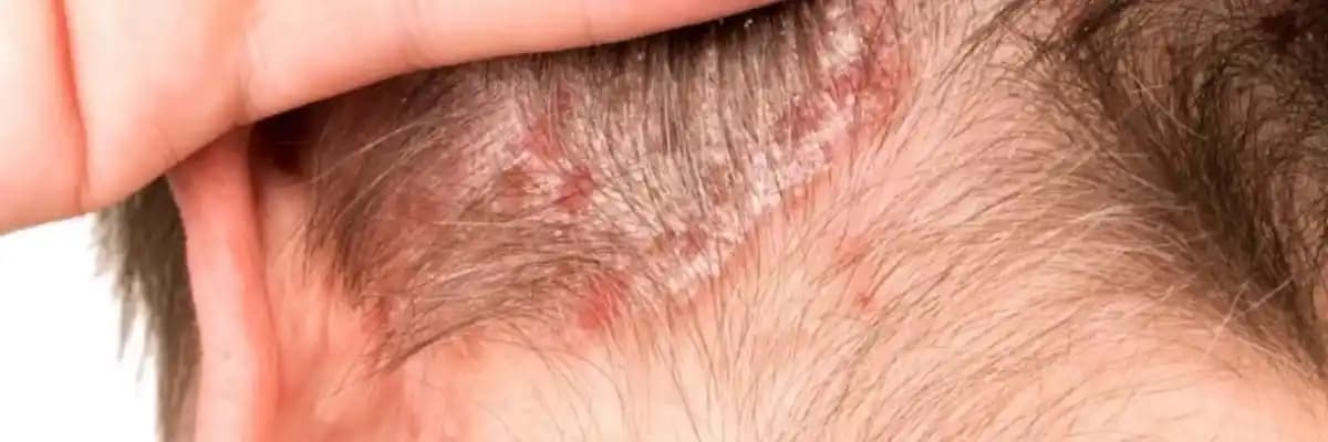 Saçta Kepekli Egzama Nedenleri Belirtileri ve Etkili Çözüm Yöntemleri