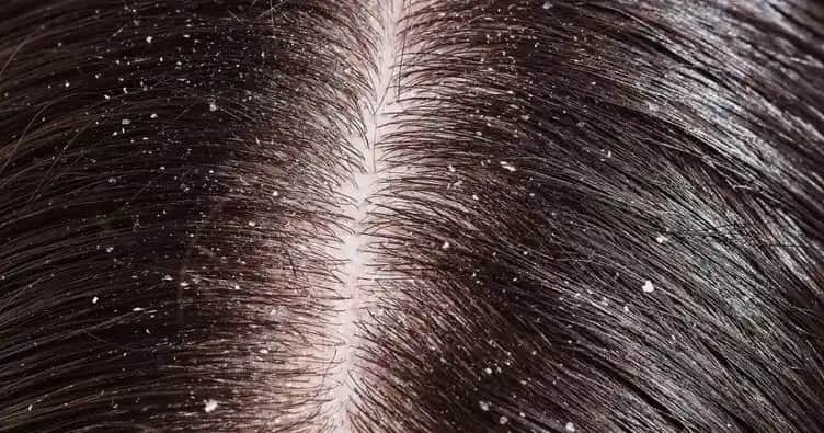 Saçta Pullanma Nedenleri ve Etkili Çözüm Yöntemleri Hakkında Kapsamlı Bilgi