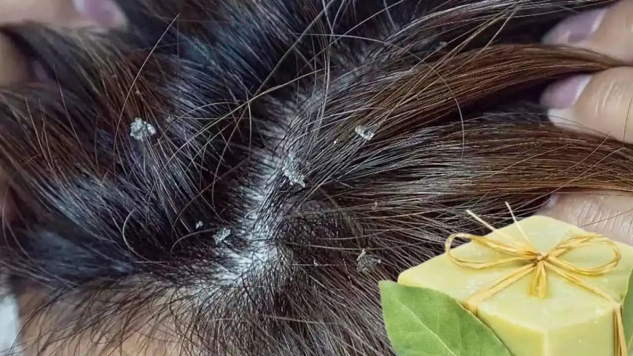 Saçtaki Egzamaya Karşı En Etkili Şampuanlar ve Bakım Yöntemleri