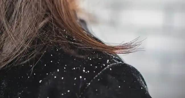 Saçtaki Kepeğe Karşı En Etkili Şampuan Seçenekleri ve Tavsiyeler