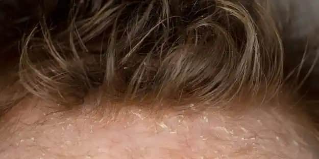 Saçtaki Kepek Nasıl Geçer? Etkili Tedavi Yöntemleri ve Doğal Çözümler