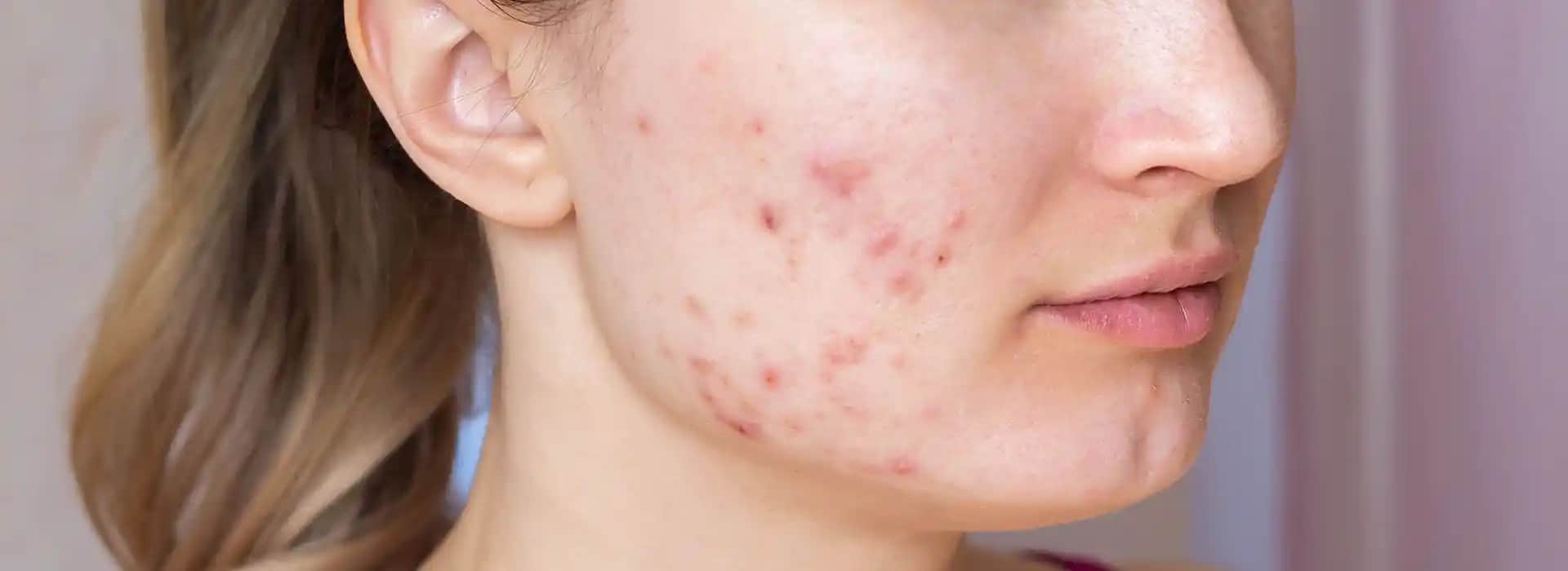 Akne ve Sivilceyle Mücadelede Etkili Kozmetik Yaklaşımlar ve Cilt Sağlığı İpuçları