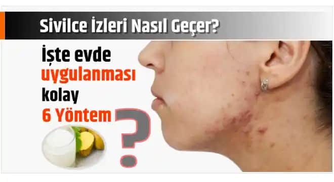 Sivilce En Kolay Nasıl Geçer: Etkili ve Pratik Yöntemler ile Cilt Sağlığını Koruma