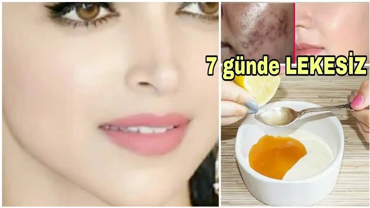 Sivilce Lekelerine Karşı En Etkili Kremler ve Doğru Kullanım Yöntemleri