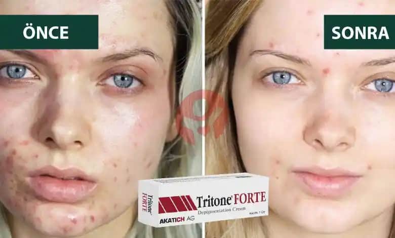 Sivilceye Karşı En Etkili Kremler ve Doğru Cilt Bakım Yöntemleri