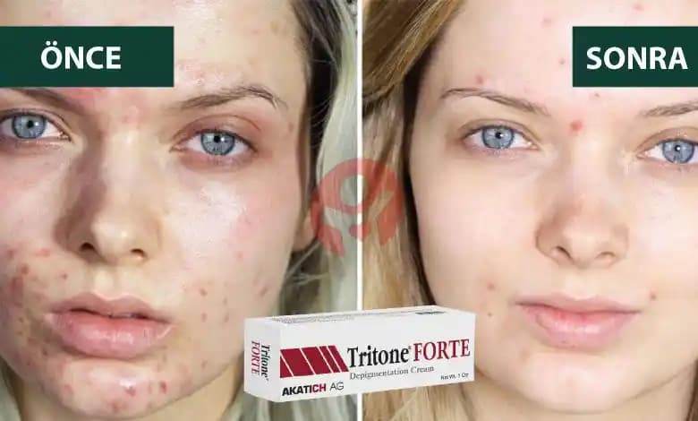 Sivilceye Karşı En Etkili Kremler ve Doğru Cilt Bakım Yöntemleri