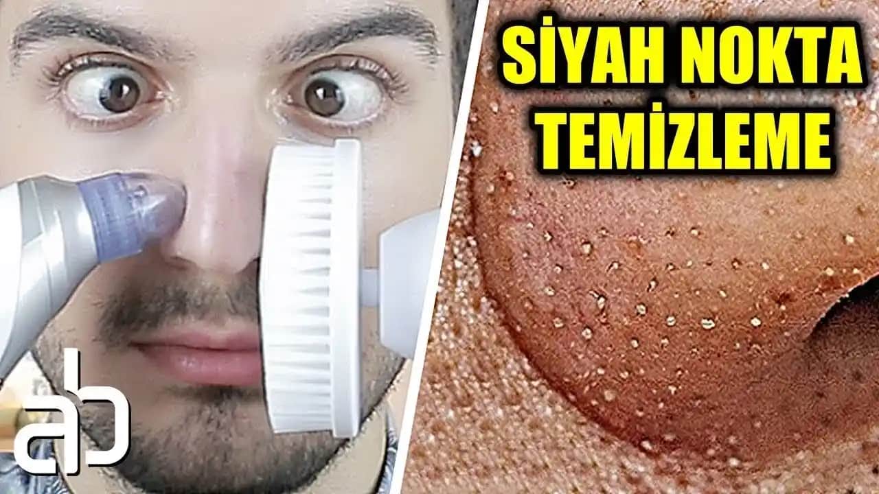 Siyah Akne Nedir, Nedenleri ve Etkili Tedavi Yöntemleri Hakkında Kapsamlı Bilgi