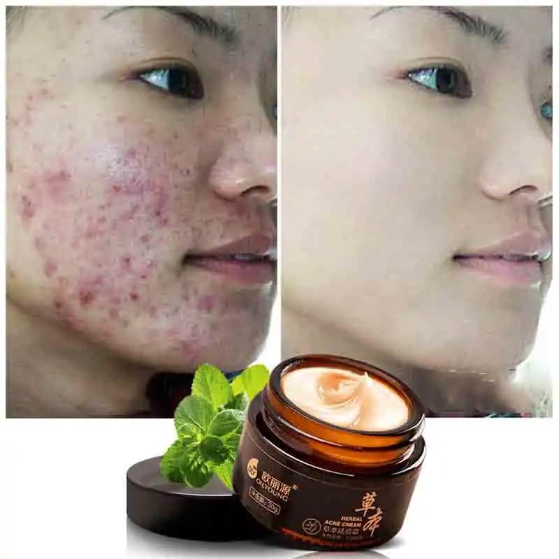 Siyah Nokta Temizleme Kremleri ve Doğru Kullanım İpuçlarıyla Pürüzsüz Cilt Sağlayın