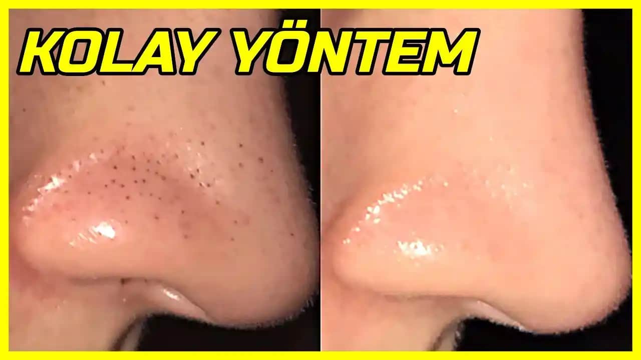 Siyah Noktalar İçin En Etkili Asitler ve Doğru Kullanım Yöntemleri Rehberi