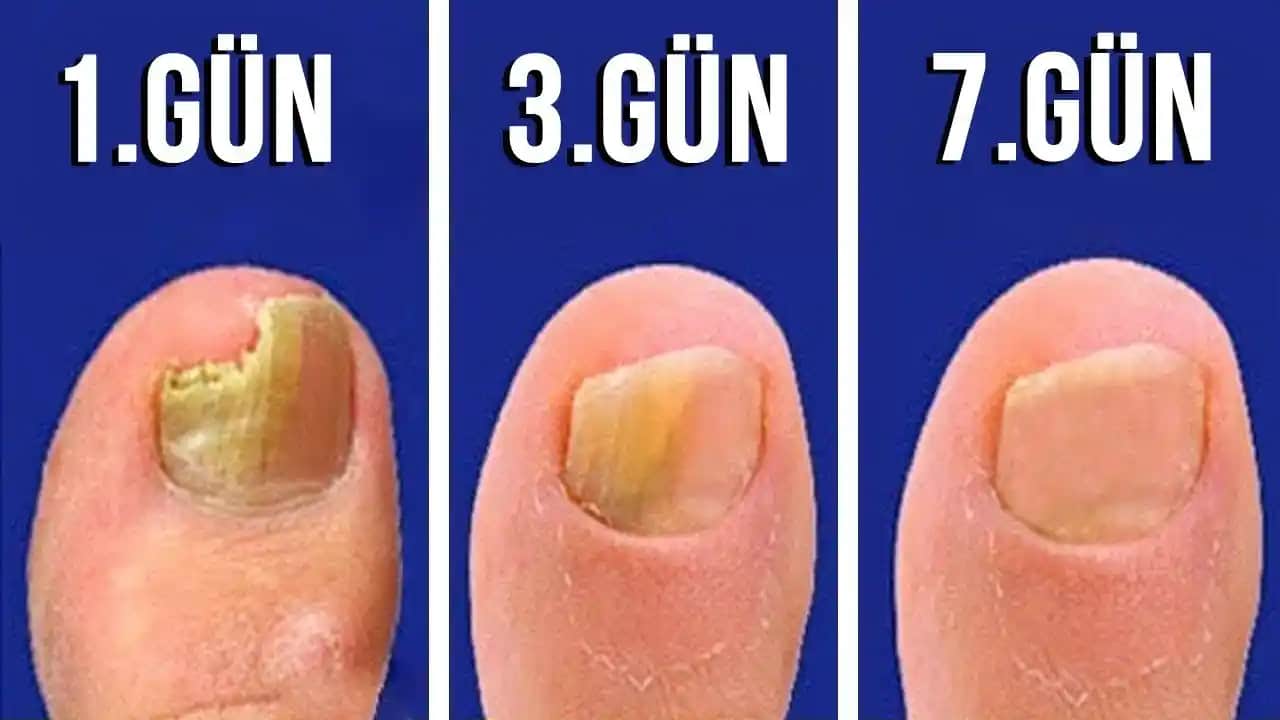 Siyah Tırnak Mantarı Nasıl Geçer Etkili Yöntemler ve Doğal Çözümler