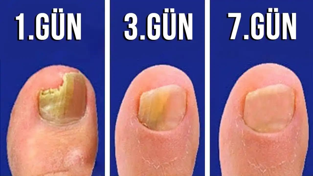 Siyah Tırnak Mantarı Nasıl Geçer Etkili Yöntemler ve Doğal Çözümler