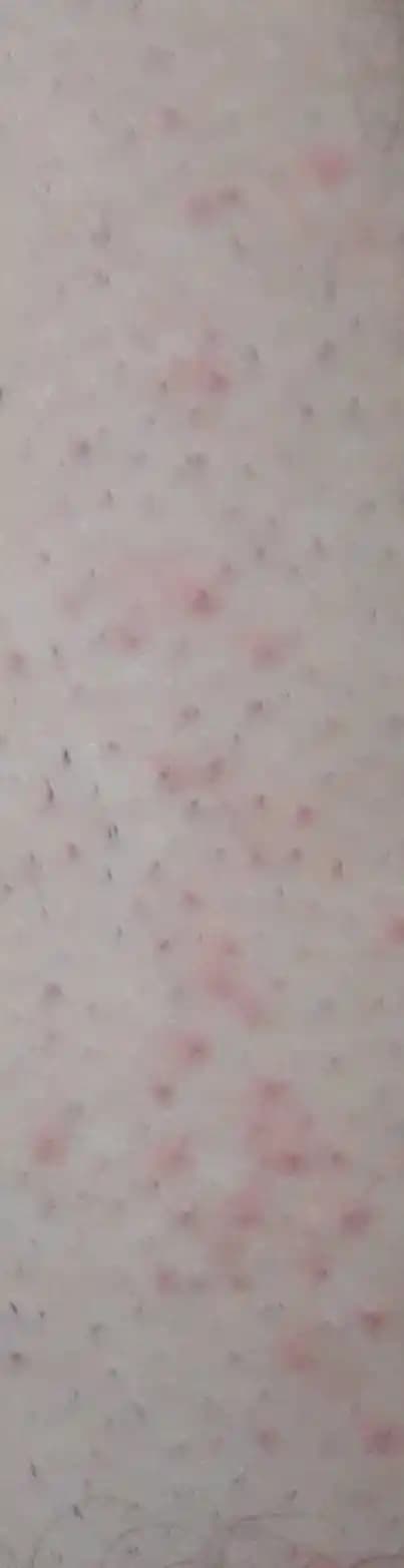 Tıraş Sonrası Kızarıklık Nasıl Geçer En Etkili Yöntemler ve İpuçları