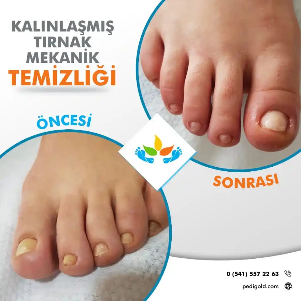 Tırnak Kalınlaştırma Yöntemleri ve Sağlıklı Tırnaklar İçin Bilmeniz Gerekenler