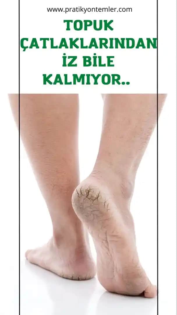 Vücut Çatlaklarına Karşı Etkili Doğal Yöntemler ve Bakım Tavsiyeleri