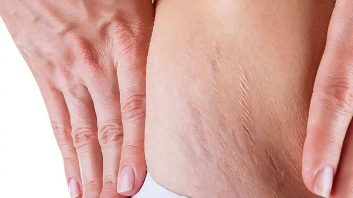 Vücutta Çatlaklar: Nedenleri, Tedavi Yöntemleri ve Korunma İpuçları Rehberi