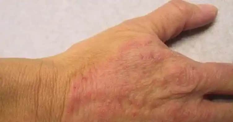 Vücutta Mantar Oluşumu, Belirtileri ve Korunma Yöntemleri Hakkında Kapsamlı Bilgi