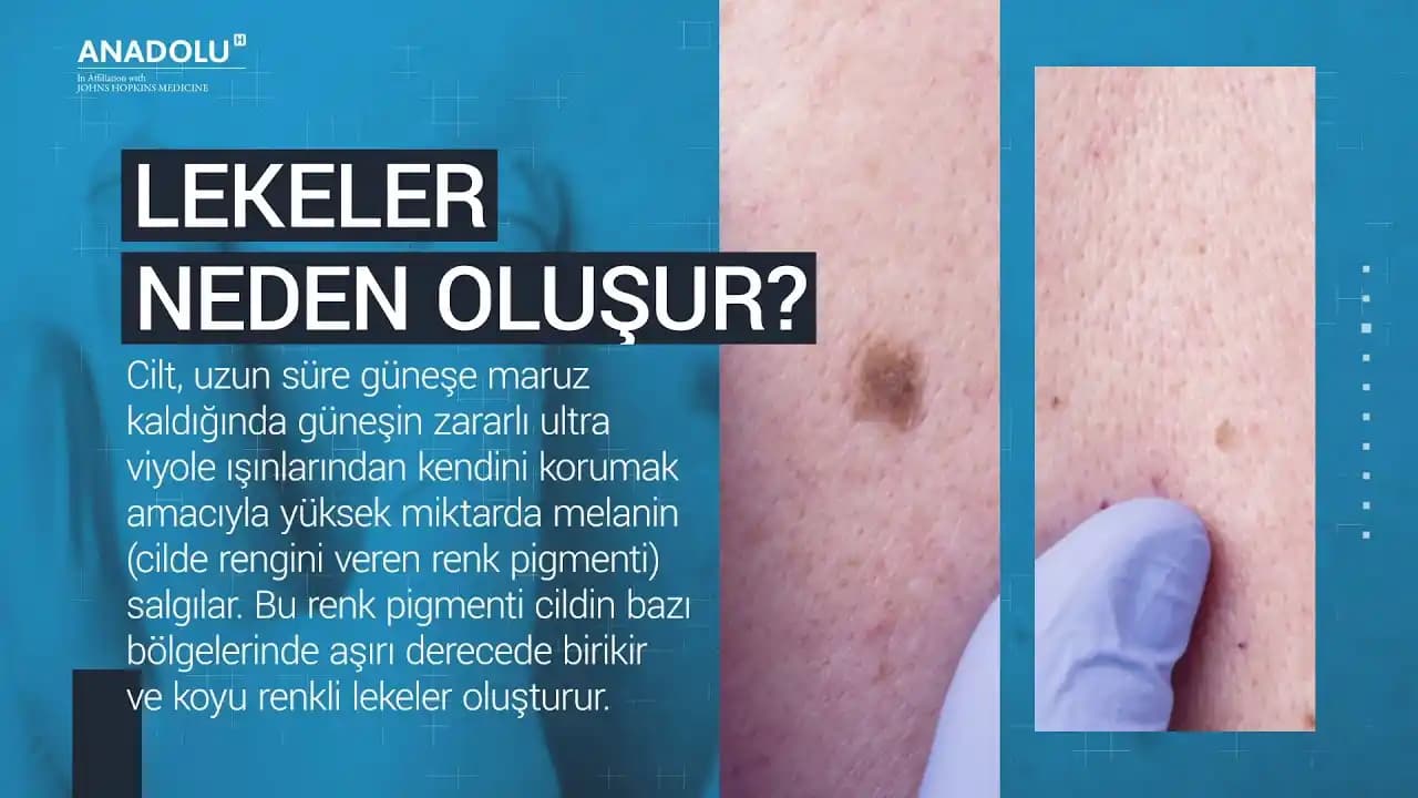 Vücutta Siyah Lekelerin Nedenleri ve Doğal Çözüm Yöntemleri Hakkında Kapsamlı Rehber
